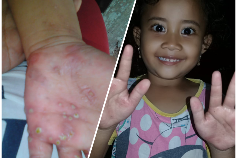 Penyakit scabies pada kulit